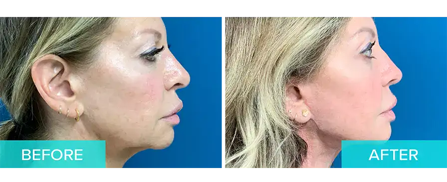 Laser Skin Resurfacing Boca Raton Lasabrasion